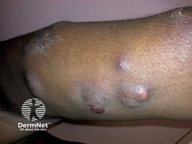Mycobacterium ulcerans infection on the arm