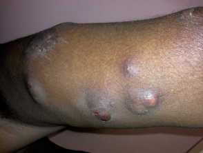 Atypical mycobacteria infection
