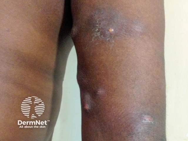 Mycobacterium ulcerans infection on the arm