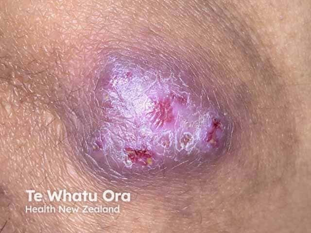 Mycobacterium marinum infection on the knee