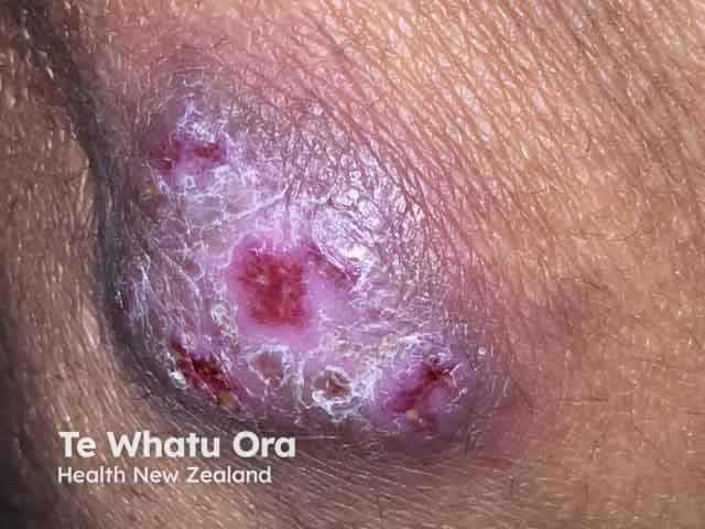 Mycobacterium marinum infection on the knee