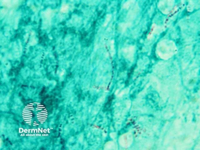 Acid fast bacilli on tissue microscopy form a fish tank granuloma