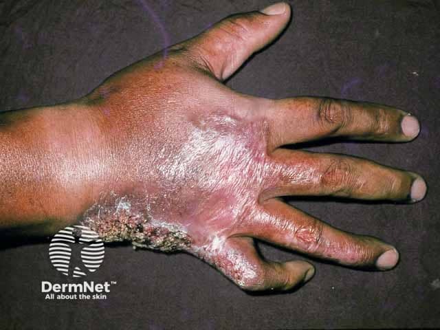 Extensive Mycobacterium marinum infection on the hand