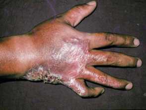 Atypical mycobacteria infection