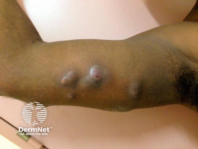 Mycobacterium ulcerans infection on the arm