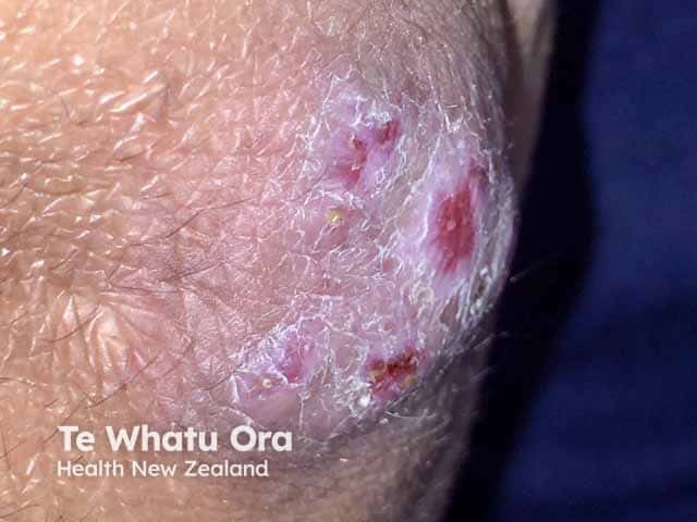 Mycobacterium marinum infection on the knee