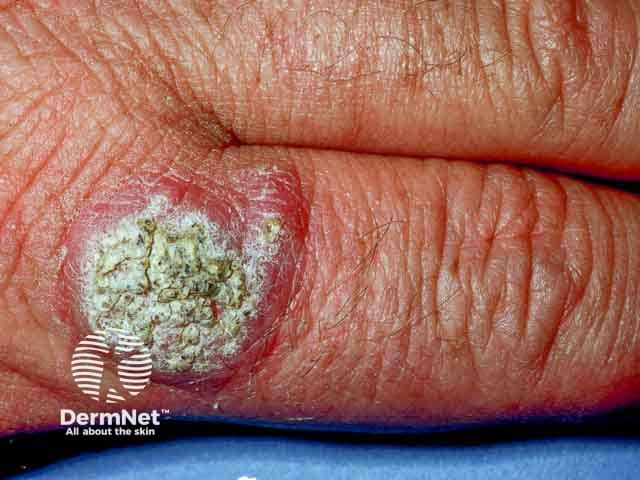 Warty Mycobacterium marinum infection