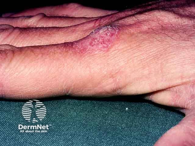 Warty Mycobacterium marinum infection