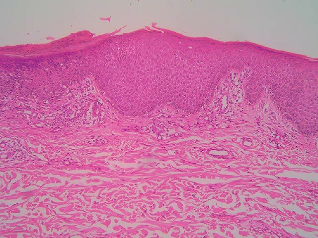 Skin biopsy findings in autonomic denervation dermatitis - mild epidermal hyperplasia with subacute spongiotic epidermal reaction and superficial perivascular dermatitis