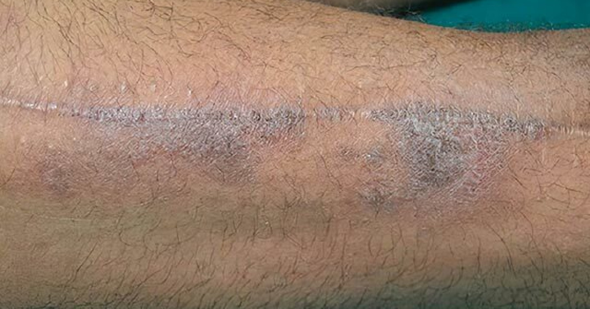 Autonomic denervation dermatitis image