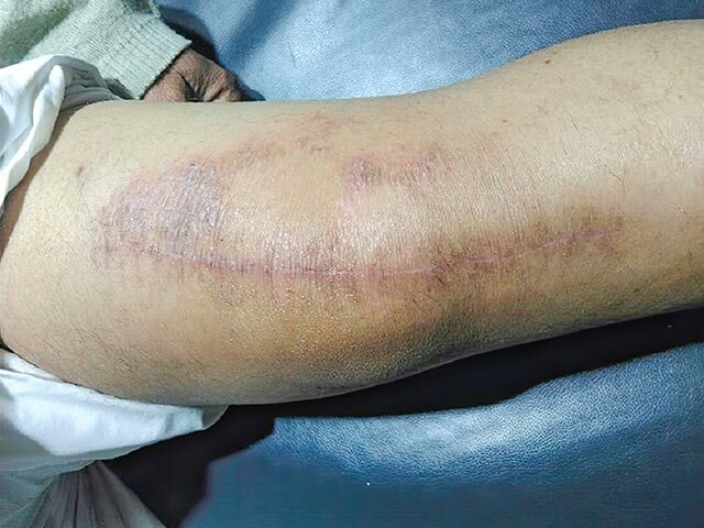 Autonomic denervation dermatitis at the site of a total knee joint replacement skin incision