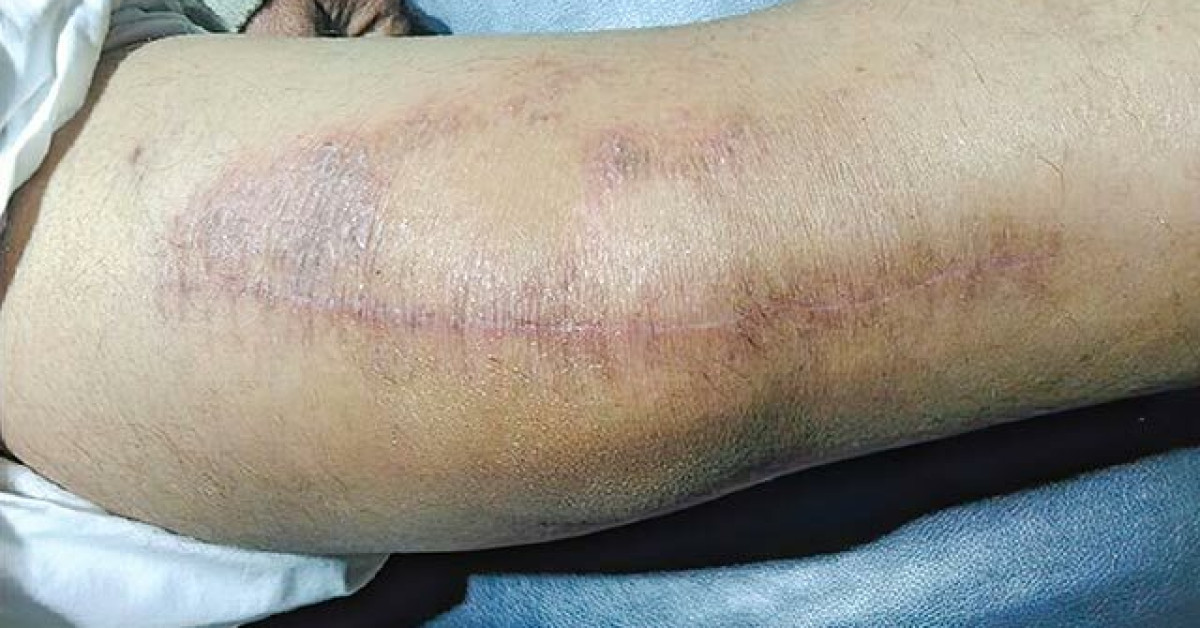Autonomic denervation dermatitis image