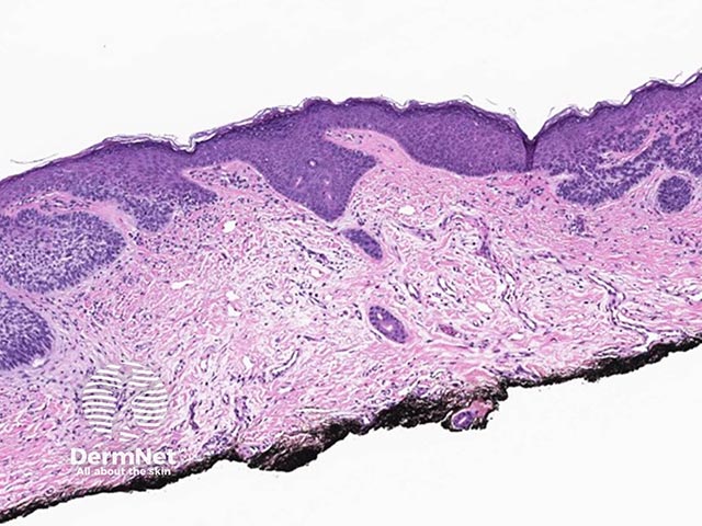 A superficial basal cell carcinoma - buds of atypical basaloid cells bud down towards the dermis