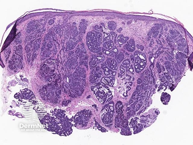 A nodular basal cell carcinoma - nodules of dark basaloid cells can be seen with a surrounding stroma