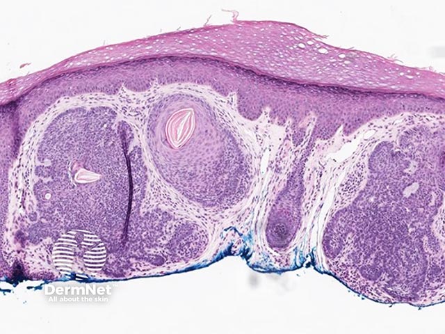 A nodular basal cell carcinoma - the peripheral palisading of the basaloid cells can be appreciated