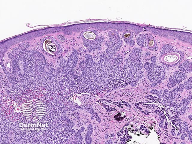 A pigmented basal cell carcinoma - flecks of melanin pigment can be seen within the stroma of the tumour