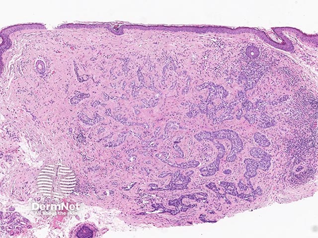 An infiltrative basal cell carcinoma - strands and buds of basaloid cells can be seen deep into the dermis