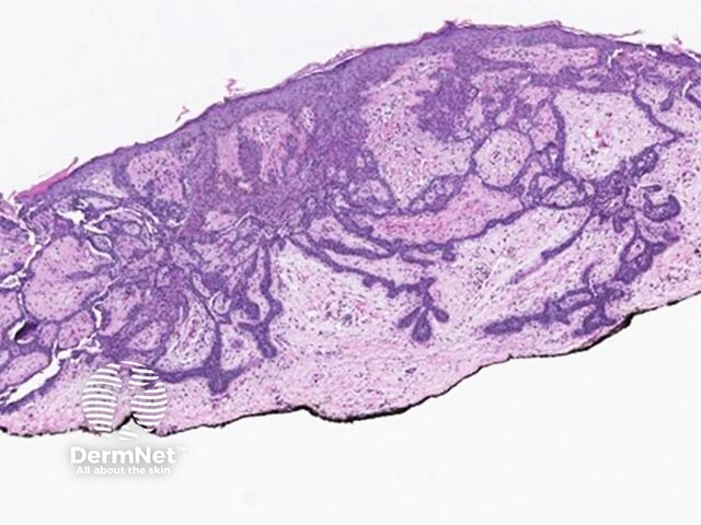 A fibroepithelioma of Pinkus - net-like interconnecting strands of basaloid cells and a vascular stroma are noted 