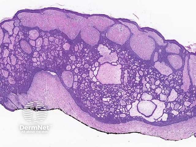 A fibroepithelioma of Pinkus - interconnecting strands of basaloid cells interspersed with vascularised stroma