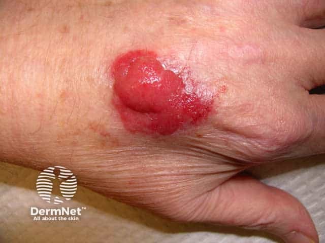 Nodular ulcerated basal cell carcinoma in HIV infection