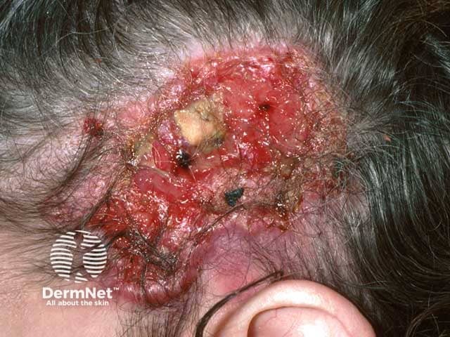 Giant neglected basal cell carcinoma ulcerated down to the skull