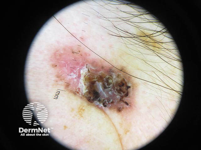 Dermoscopy of a pigmented basal cell carcinoma 