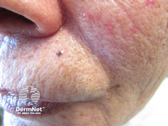 A small pigmented basal cell carcinoma on the upper lip