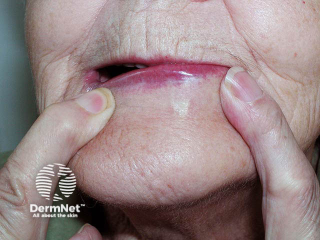 A morphoeic basal cell carcinoma on the left lower lip - it is more easily seen when the skin is stretched