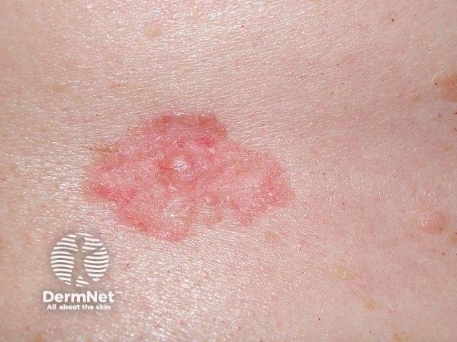 A superficial basal cell carcinoma - they are often pink and have an irregular thread-like edge