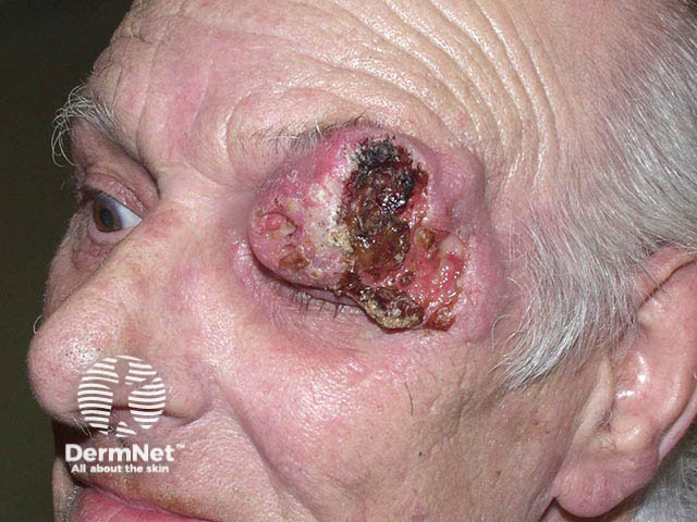 An advanced and neglected basal cell carcinoma on the eyelid