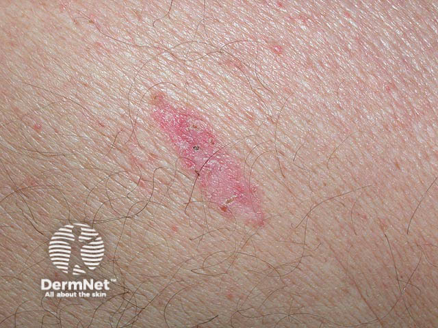 A slowly-spreading pink and well-marginated superficial basal cell carcinoma