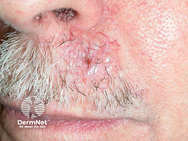 A nodulocystic basal cell carcinoma on the upper lip - the enlarged vessels coursing over the pearly tumour are characteristic