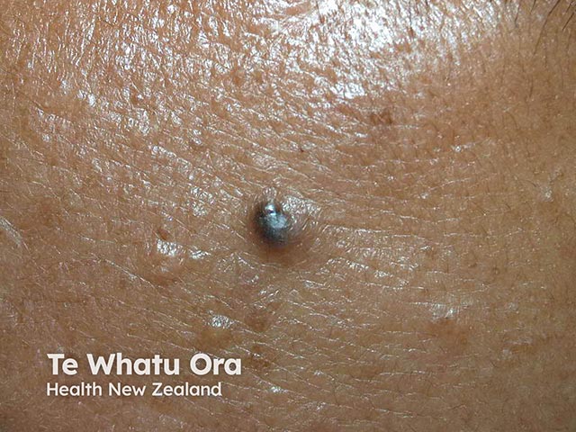 A small pigmented basal cell carcinoma in skin of colour