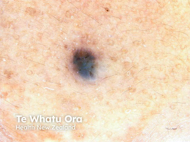 A small pigmented basal cell carcinoma on dermoscopy