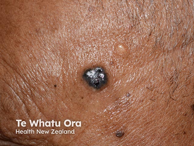 A nodular pigmented basal cell carcinoma in a Māori patient