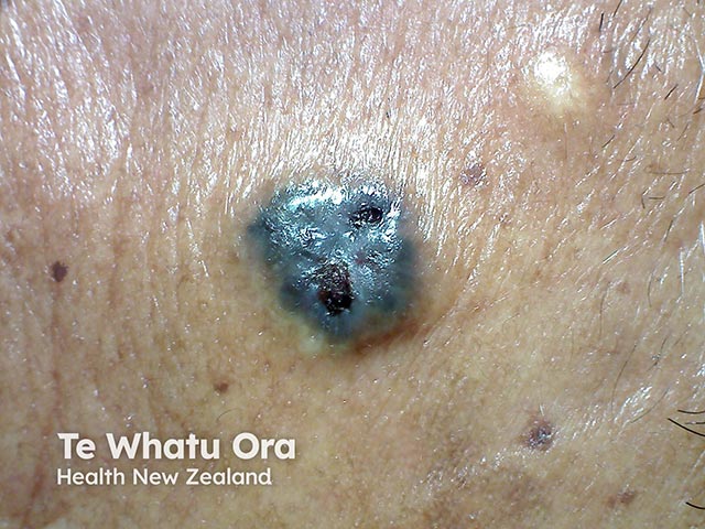 A nodular pigmented basal cell carcinoma in a Māori patient