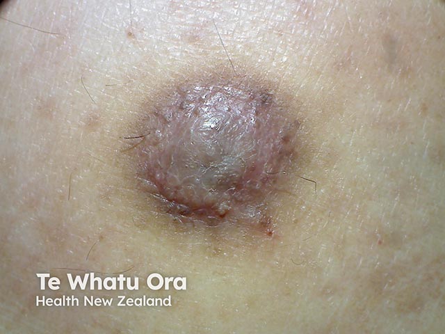 Superficial basal cell carcinoma arising in a dermatofibroma on the calf