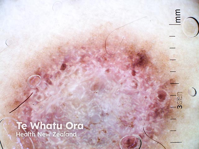 A superficial basal cell carcinoma arising over a dermatofibroma