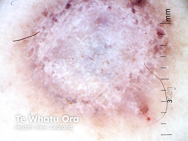 A superficial basal cell carcinoma arising over a dermatofibroma