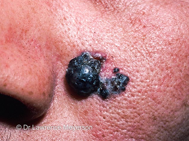 A pigmented nodular basal cell carcinoma in skin of colour