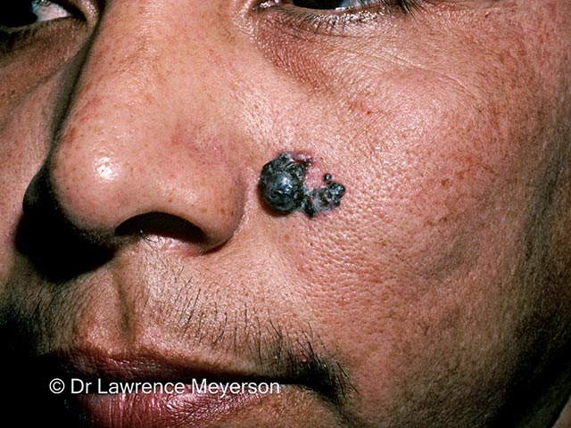 A pigmented nodular basal cell carcinoma in skin of colour