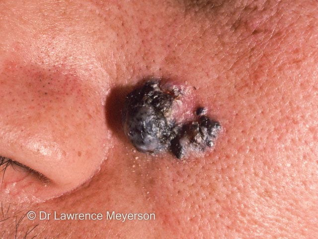 A pigmented nodular basal cell carcinoma in skin of colour