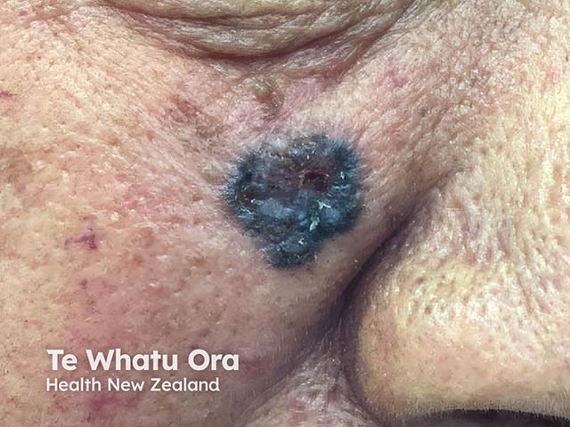 A pigmented basal cell carcinoma in skin of colour