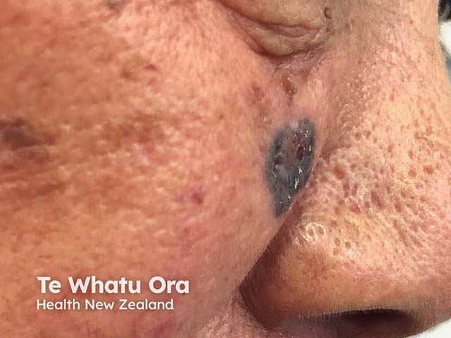 A pigmented basal cell carcinoma in skin of colour