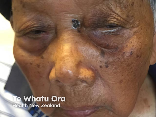 A pigmented basal cell carcinoma in an elderly South East Asian woman