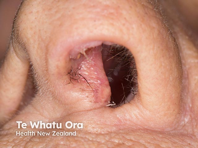 A basal cell carcinoma within the nasal vestibule