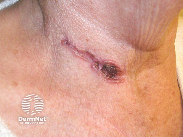 A linear basal cell carcinoma on the neck