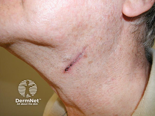 A linear basal cell carcinoma on the neck