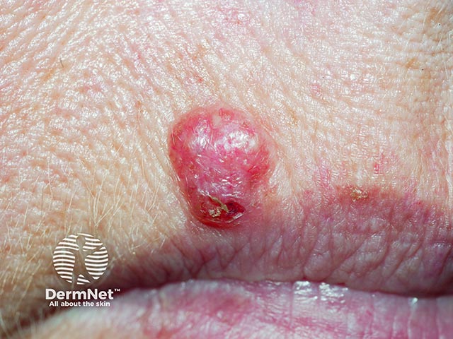 A nodular basal cell carcinoma on the lip - note the inferior ulceration