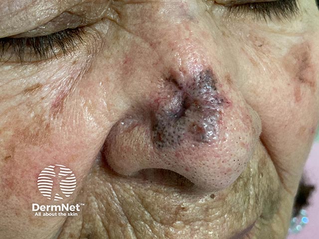 A pigmented basal cell carcinoma on the nose